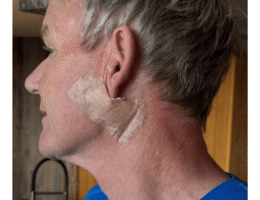 Kanker Kulit Karsinoma