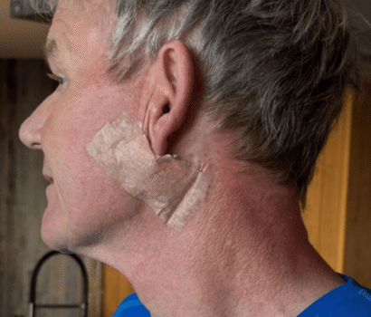 Kanker Kulit Karsinoma