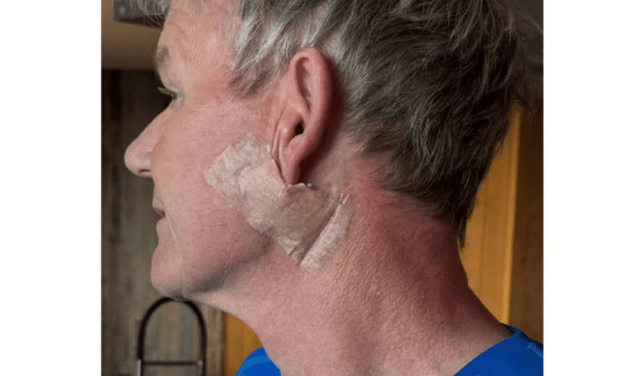 Kanker Kulit Karsinoma