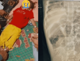 Cacingan Anak Stunting