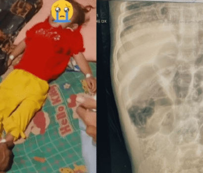 Cacingan Anak Stunting