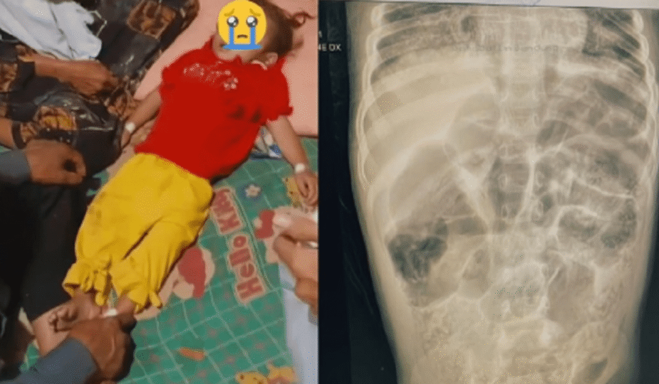 Cacingan Anak Stunting