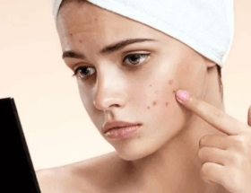 Menyembuhkan jerawat meradang