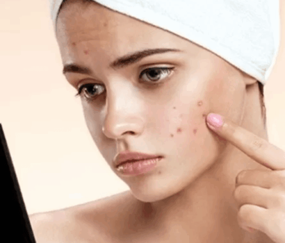 Menyembuhkan jerawat meradang