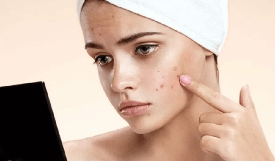 Menyembuhkan jerawat meradang