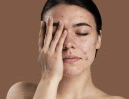 Menyamarkan Jerawat dengan Makeup