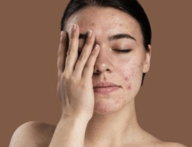 Menyamarkan Jerawat dengan Makeup