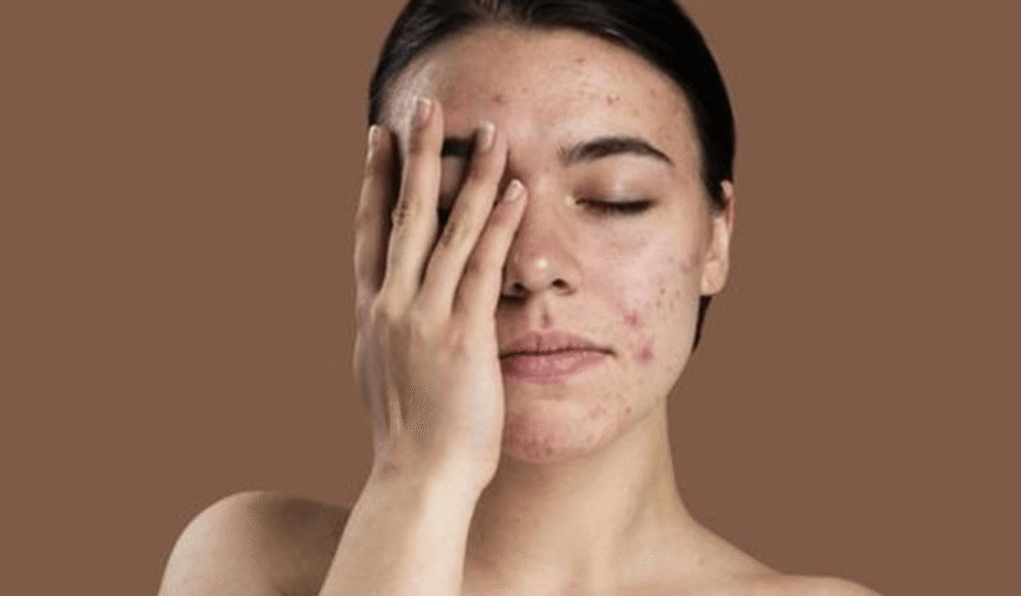 Menyamarkan Jerawat dengan Makeup