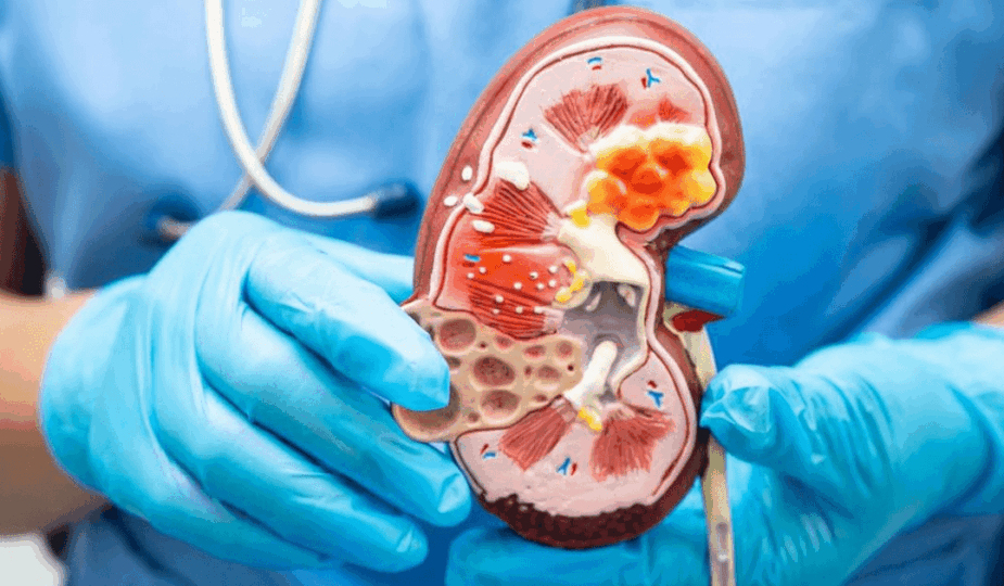 Perubahan Warna Urine